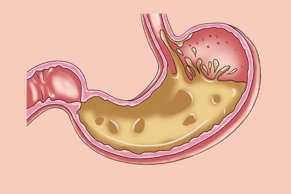 胃酸“克星”奥美拉唑，连续吃上三年、五年身体会咋样了解一下