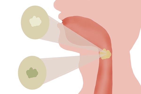 提醒：吐口痰观察肺部健康，四种颜色痰液危险建议检查，对照看看