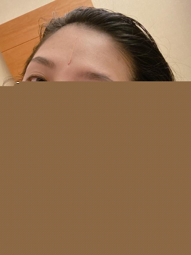 看着都疼，跳水女神放血调理身体，额头扎针，脖子手臂都留淤血