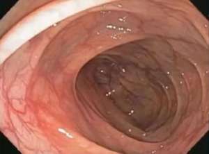 这种息肉可能会变成癌！排便出现这4种异常建议及时就医