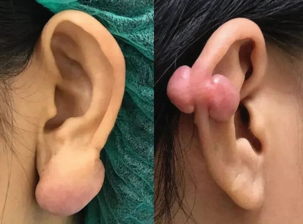 为什么没有人告诉我，打耳洞后会长这种肉疙瘩啊？